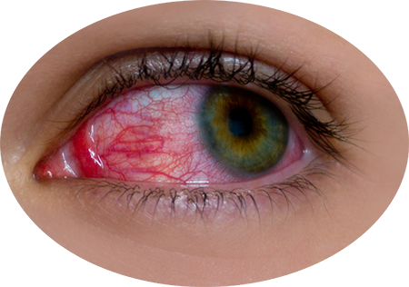 Ocular Emergencies and Chronic Ocular Diseases
